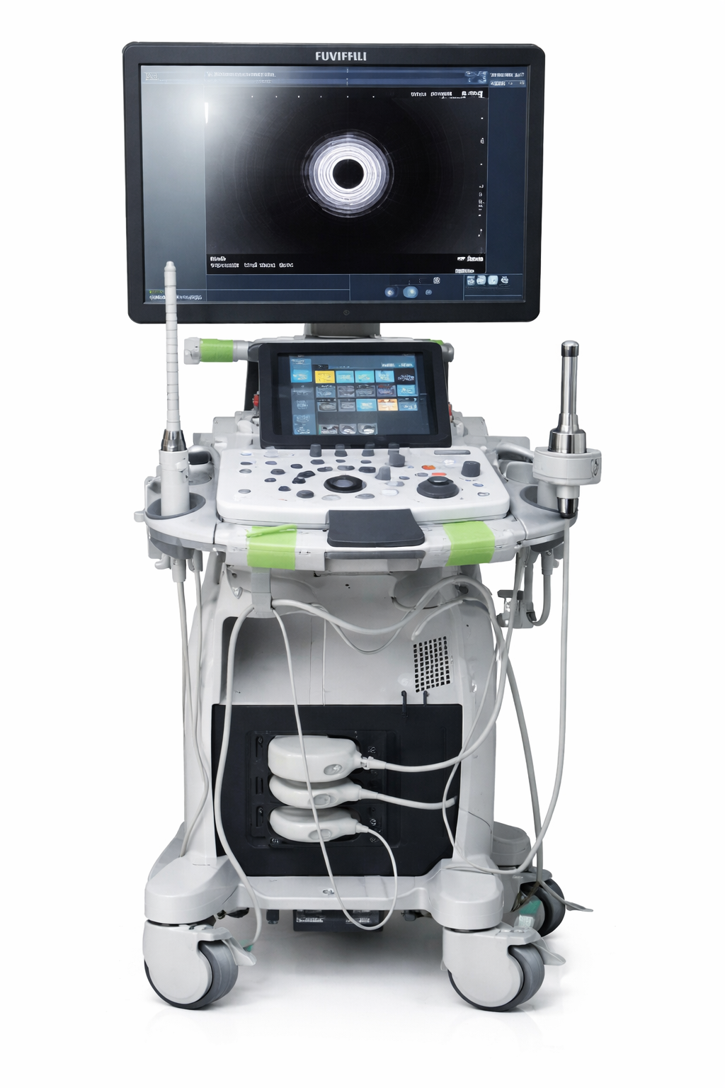 Highlighted medical image of a fistula